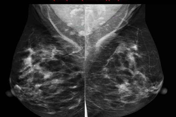 Ανδριανή Τζίμα, Εικόνα προληπτικής μαστογραφίας, πηγή: mammography.gr